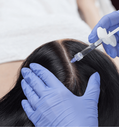 Mesoterapia médica anti caída