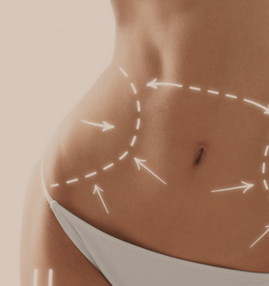 Lipo Cell Crio paquete 12 sesiones